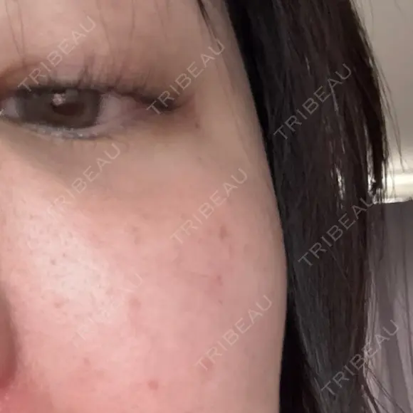 ルメッカ ルラ美容クリニック 岐阜院 BEFORE メイン用