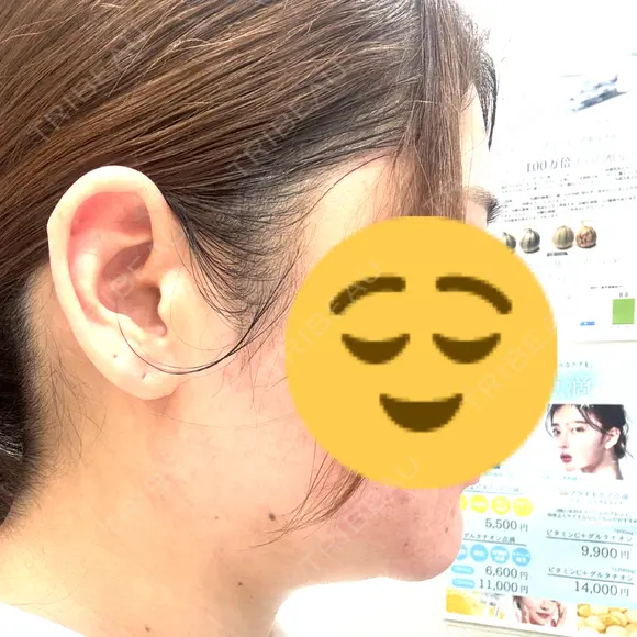 インモード PureMe Skin Clinic（ピュアミースキンクリニック麻布） BEFORE メイン用