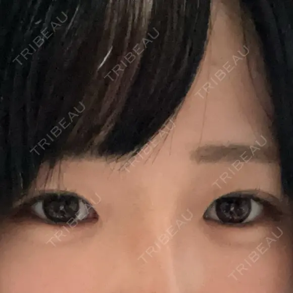 二重埋没 / 目頭切開 / 目尻切開 / タレ目形成・グラマラスライン（切開） ziz CLINIC BEFORE メイン用