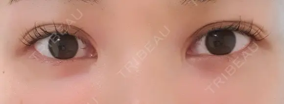 二重切開 CLASSY 仙台美容外科・美容皮膚科 BEFORE メイン用