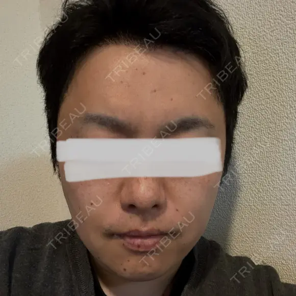 脂肪溶解注射（顔） 上野注入クリニック BEFORE メイン用