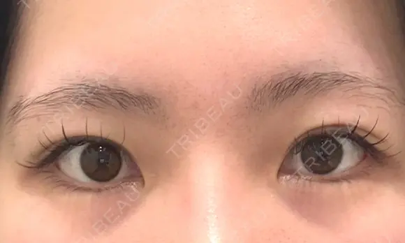 二重埋没 / 目頭切開 / 自然癒着法 Brandnew Beauty Clinic BEFORE メイン用