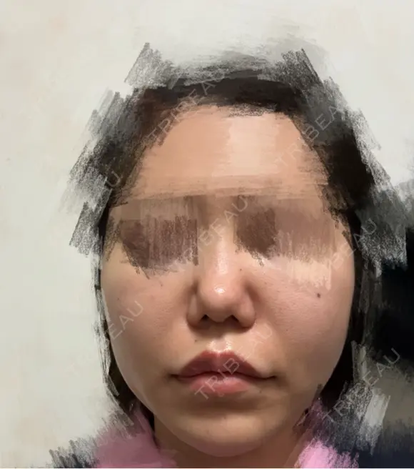 糸リフト / ボトックス（あご） / ボトックス（眉間） / ボトックス（目尻） / ボトックス（額） TCB東京中央美容外科 高崎院 BEFORE メイン用