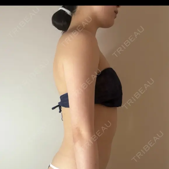 脂肪吸引（顔） / 脂肪吸引（二の腕） / 脂肪吸引（肩） GAYA body design clinic BEFORE メイン用