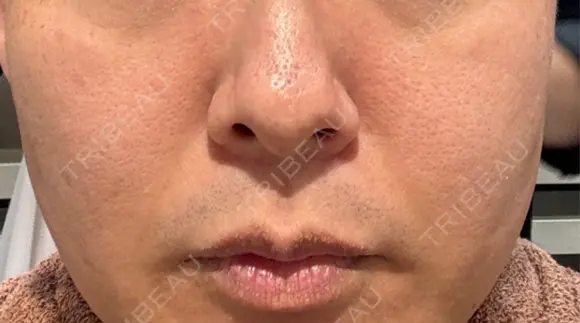 美肌レーザー / シミ取りレーザー / 美白レーザー / エレクトロポレーション / 毛穴洗浄（ハイドラフェイシャルなど） / ピコレーザートーニング（美白・肝斑） / フラクショナルレーザー（毛穴・ニキビ跡） / レーザートーニング（美白・肝斑） Fellez Clinic【フェルズクリニック】 BEFORE メイン用