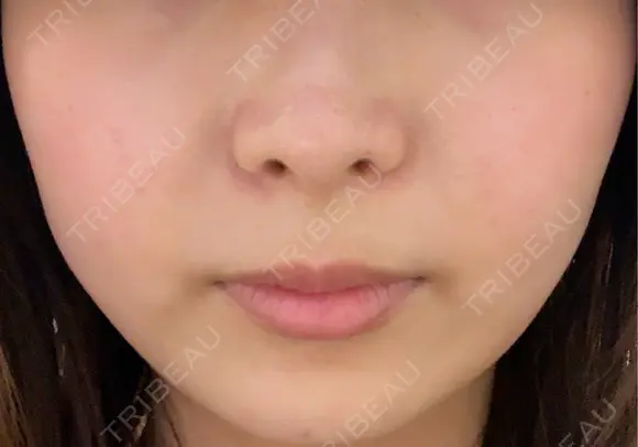 その他（輪郭） / 医療痩身（顔） / その他（肌） / RF（高周波）たるみ治療 / オンダリフト ライブリークリニック 船橋院 BEFORE メイン用