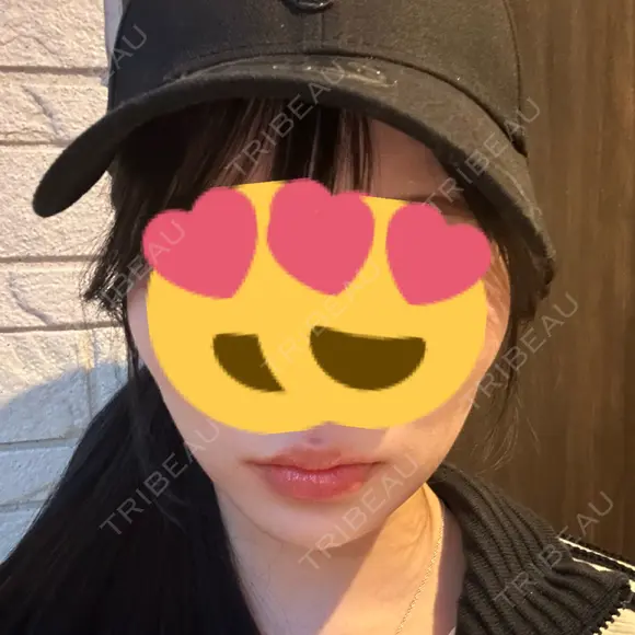 ヒアルロン酸注入（唇） / ヒアルロン酸注入（頬） / ヒアルロン酸注入（鼻翼基部） ルラ美容クリニック 名古屋栄院 / ルラスキンクリニック 名古屋栄院 BEFORE メイン用