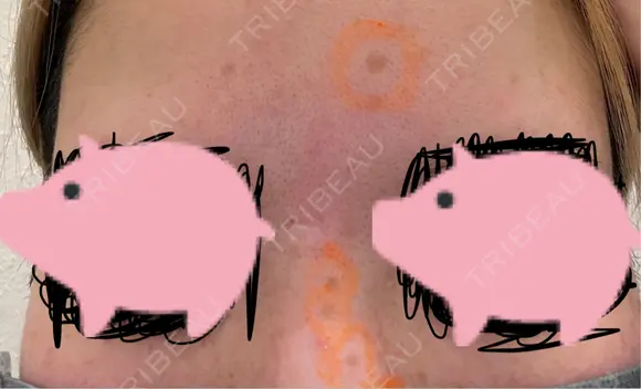 シミ取りレーザー eクリニック 金沢本院 BEFORE メイン用