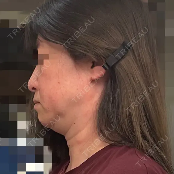 オンダリフト Wing clinic 豊中駅前院 BEFORE メイン用