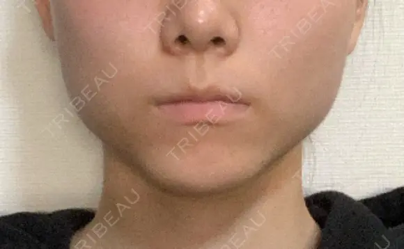 ボトックス（エラ・小顔） / 脂肪溶解注射（顔） コスメディカルクリニック シンシア 銀座院 BEFORE メイン用