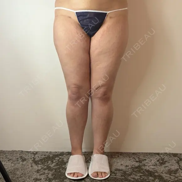 脂肪吸引（脚） / 脂肪吸引（お尻） GAYA body design clinic BEFORE メイン用