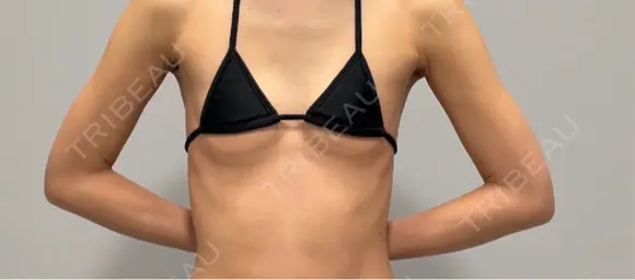 豊胸（シリコンバッグ） さくらバストクリニック BEFORE メイン用