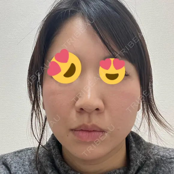 デンシティ 城本クリニック 新宿院 BEFORE メイン用