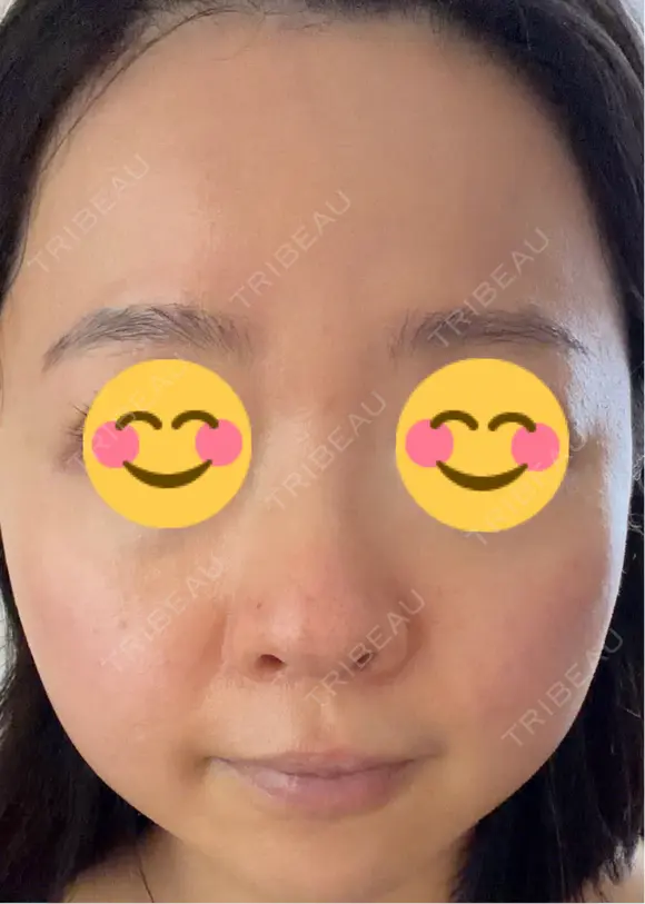 ニードルRF（ポテンツァなど） エトワールレジーナクリニック新宿院 BEFORE メイン用