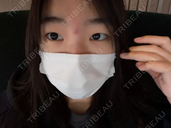 眼瞼下垂（切開） BIANCA銀座 BEFORE メイン用