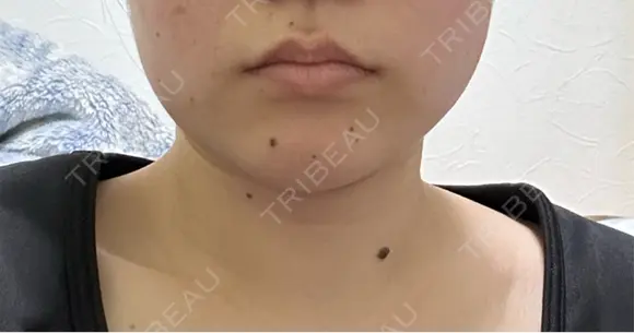 ボトックス（エラ・小顔） / ボトックス（肩） アリエル美容クリニック 水戸院 BEFORE メイン用