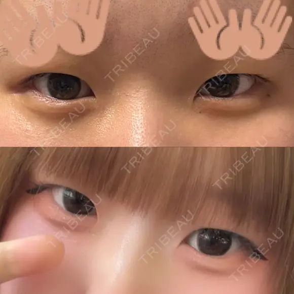 二重埋没 ルラ美容クリニック 渋谷本院 BEFORE メイン用