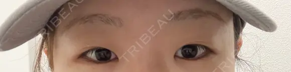 二重埋没 アリエル美容クリニック 郡山院 BEFORE メイン用