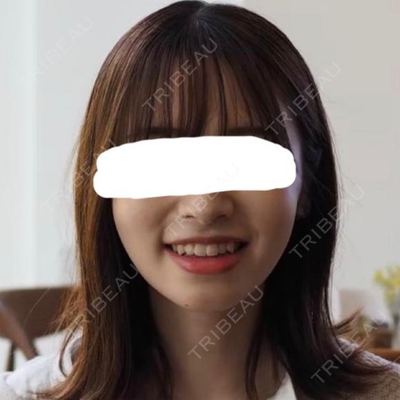 脂肪溶解注射（顔） 赤坂プレミアクリニック BEFORE メイン用
