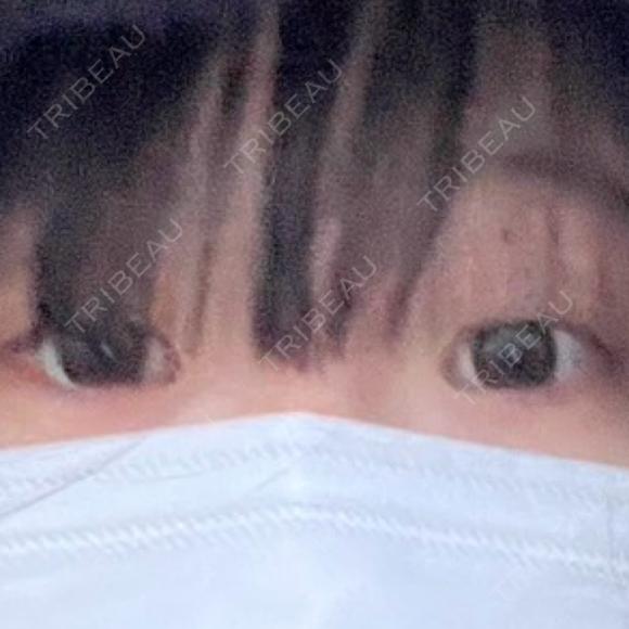 二重埋没 湘南美容クリニック 千葉センシティ院 BEFORE メイン用
