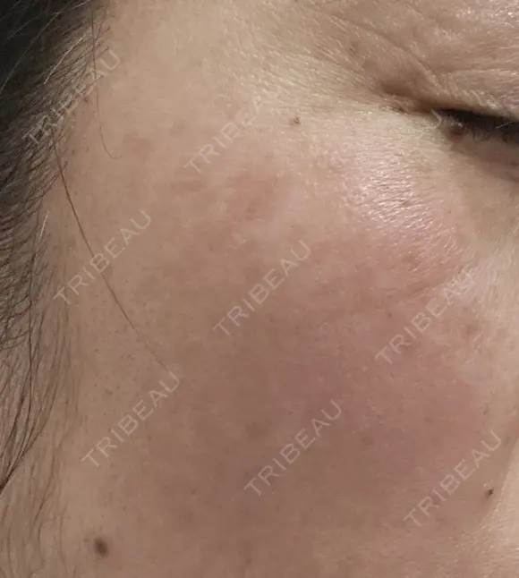 ルメッカ 広島本通り美容クリニック BEFORE メイン用