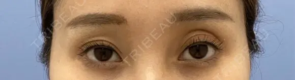 眼瞼下垂（切開） RÉ CLINIQUE SENDAI BEFORE メイン用
