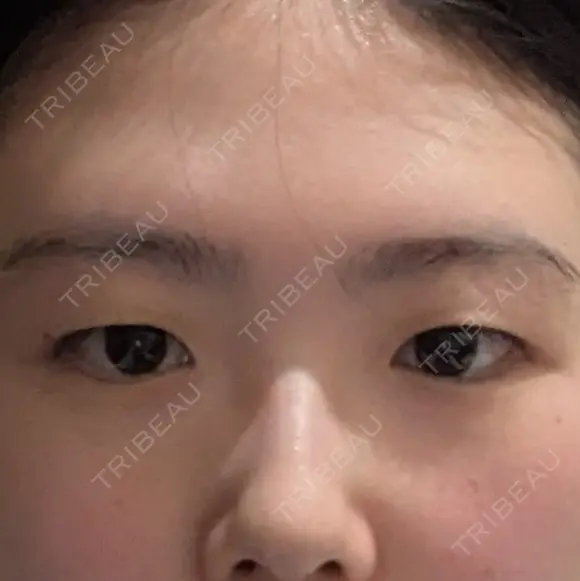上まぶたの脂肪取り / 眉下切開 新宿美容外科ネビュラクリニック BEFORE メイン用