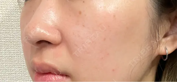 ルメッカ / LDM・インテンスウルトラ Chloe Cheongdam Clinic （クロエチョンダムクリニック） BEFORE メイン用
