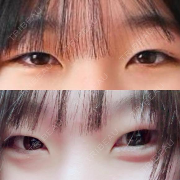 二重埋没 湘南美容クリニック 千葉センシティ院 BEFORE メイン用