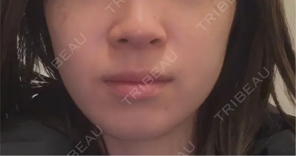 ボトックス（エラ・小顔） PRO CLINIC プロクリニック 銀座院 BEFORE メイン用
