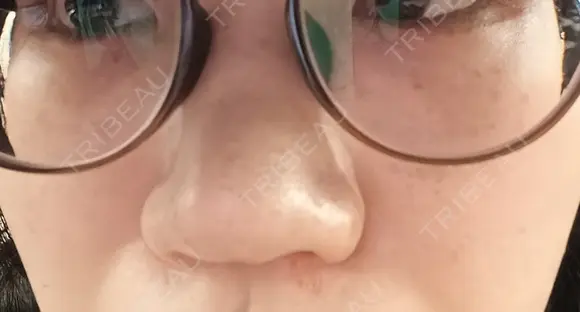 ルメッカ やさしい美容皮膚科・皮フ科　秋葉原院 BEFORE メイン用