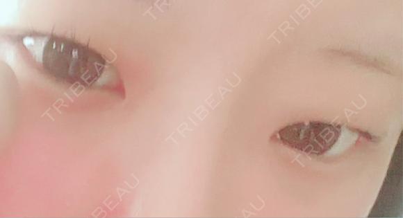 二重埋没 / 上まぶたの脂肪取り アリエル美容クリニック 郡山院 BEFORE メイン用