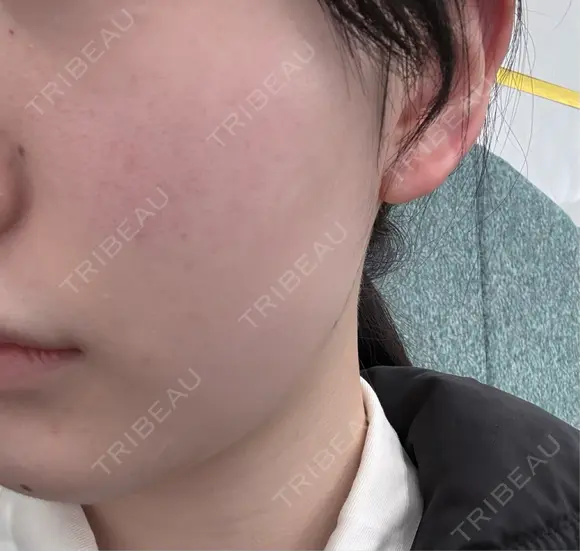 オンダリフト HAAB CLINIC 池袋院 BEFORE メイン用