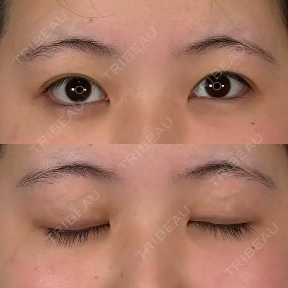 二重埋没 アリエル美容クリニック 横浜院 BEFORE メイン用