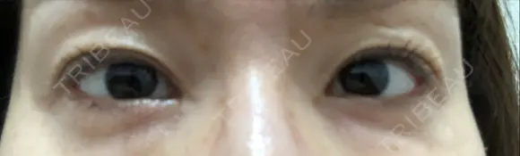 二重切開 / 眼瞼下垂（切開） / タレ目形成・グラマラスライン（切開） 湘南美容クリニック 辻堂アカデミア BEFORE メイン用