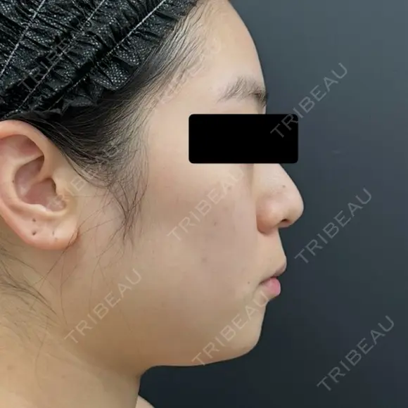糸リフト / 脂肪吸引（顔） BLINC CLINIC （ブリンク クリニック） BEFORE メイン用