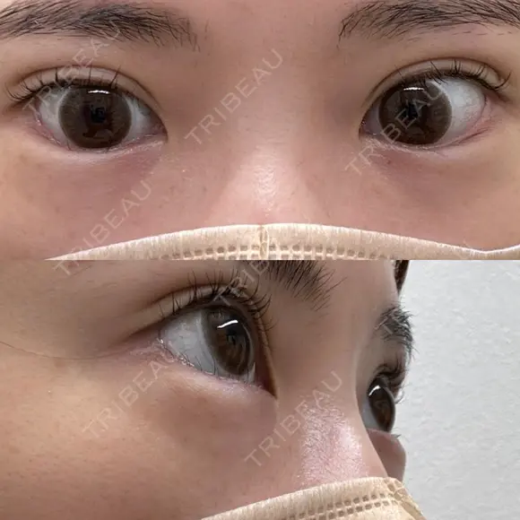 ヒアルロン酸溶解 Kinshicho Beauty Clinic （錦糸町ビューティークリニック） BEFORE メイン用