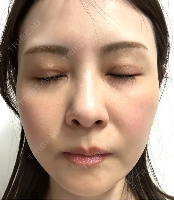 スネコス けやき美容クリニック 沼津院 BEFORE メイン用