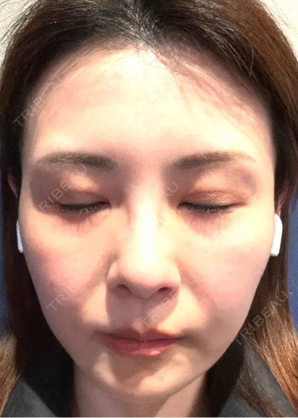 ダーマペン けやき美容クリニック 沼津院 BEFORE メイン用