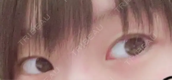 二重埋没 湘南美容クリニック 千葉センシティ院 BEFORE メイン用