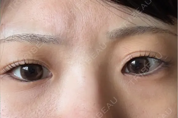 目頭切開 Stand by Beauty Clinic BEFORE メイン用