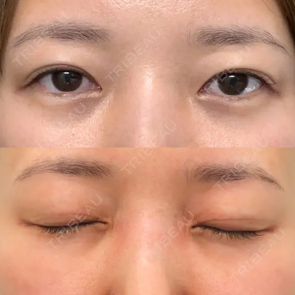 眼瞼下垂（切開） / 下まぶたたるみ取り WOM CLINIC GINZA （ワム クリニック ギンザ） BEFORE メイン用