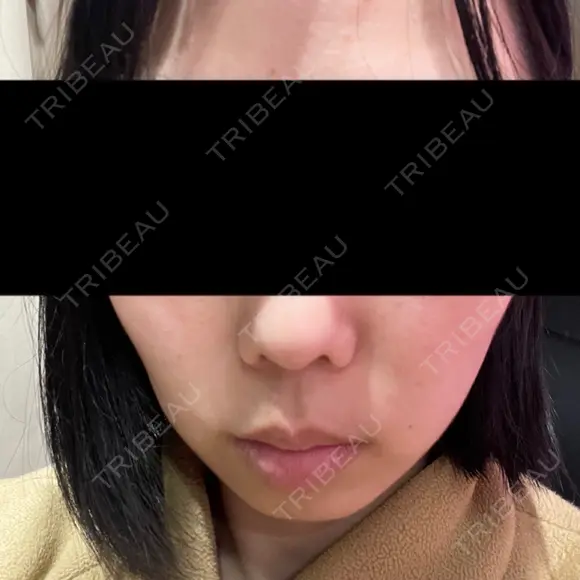 光治療（フォトフェイシャルなど） トラスト美容クリニック 銀座院 BEFORE メイン用