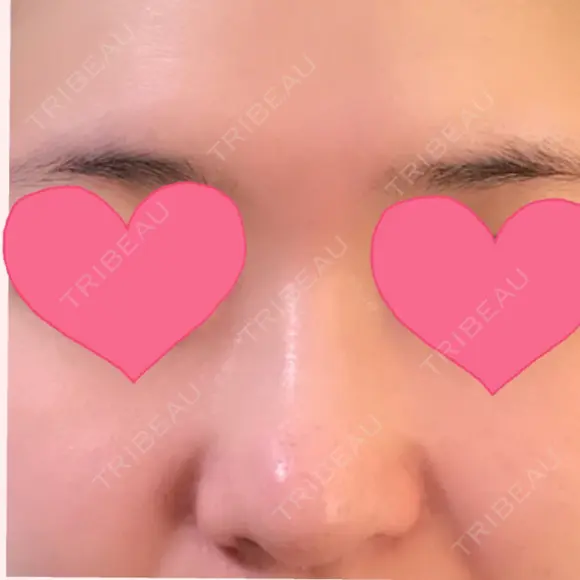 その他（鼻） / 糸リフト / 鼻修正 / ヒアルロン酸注入（額） Beauty Clinic the GINZA BEFORE メイン用
