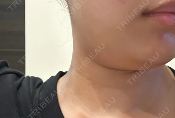 インモード 名古屋美容外科 BEFORE メイン用
