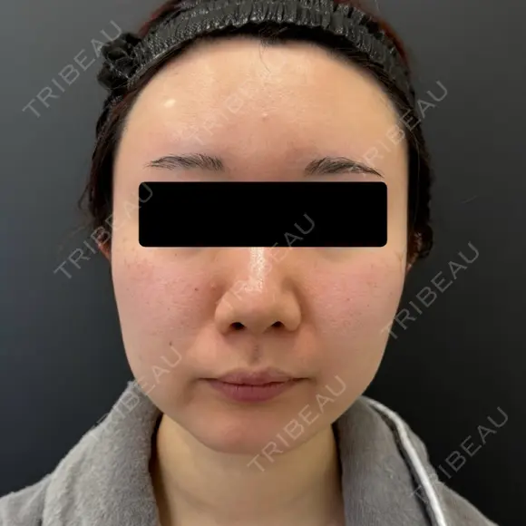 糸リフト / ジョールファット除去 BLINC CLINIC （ブリンク クリニック） BEFORE メイン用