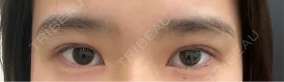 二重埋没 eクリニック 那覇院 BEFORE メイン用