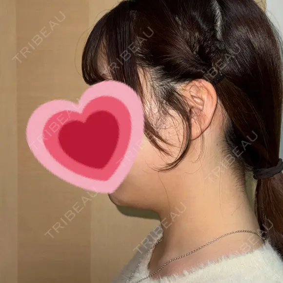 その他（輪郭） おおかみ美容のクリニック 新宿院 BEFORE メイン用