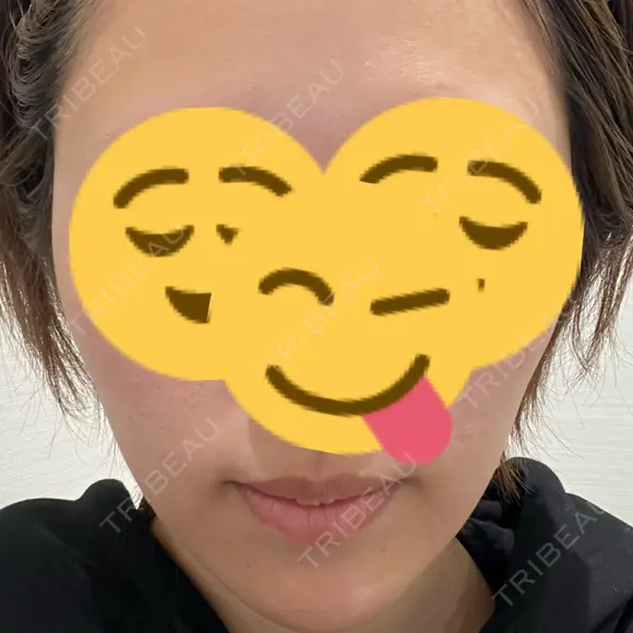光治療（フォトフェイシャルなど） トラスト美容クリニック 銀座院 BEFORE メイン用