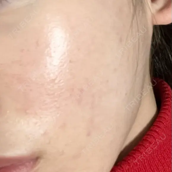 光治療（フォトフェイシャルなど） トラスト美容クリニック 銀座院 BEFORE メイン用